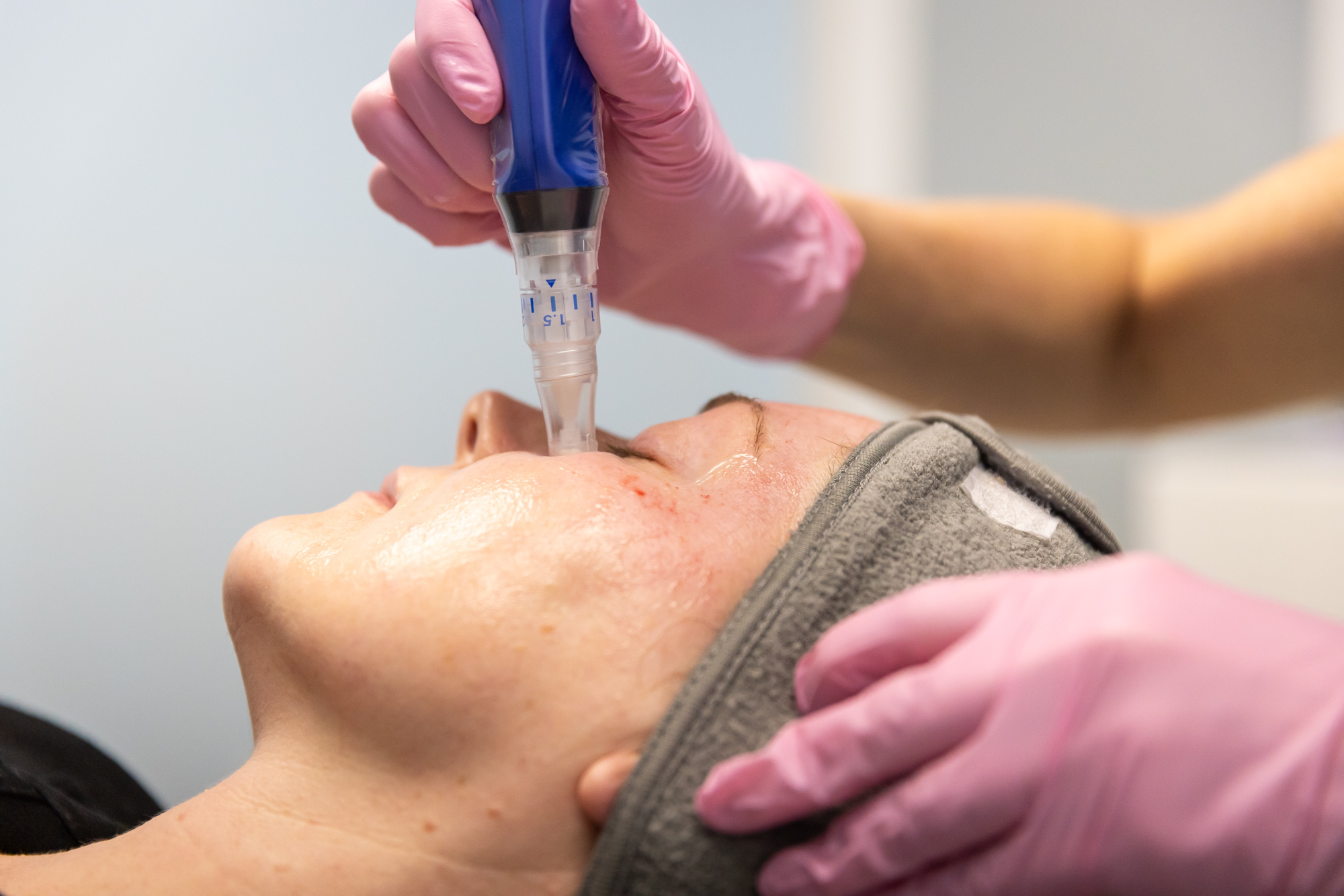 A patient relaxes on her back as she receives her anti-aging in Southlake treatment using microneedling. Her provider, wearing medical gloves, carefully glides the SkinPen handheld device over the patient's cheeks.